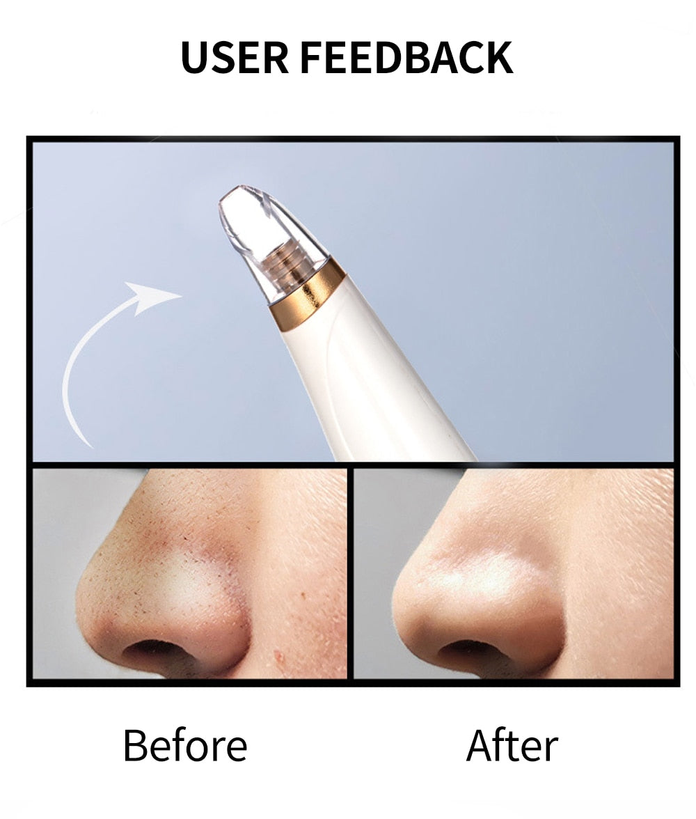 Blackhead Remover Vacuum – Deep Pore Cleaner